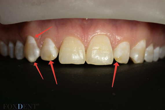 Флюороз  и гипоплазия эмали зуба