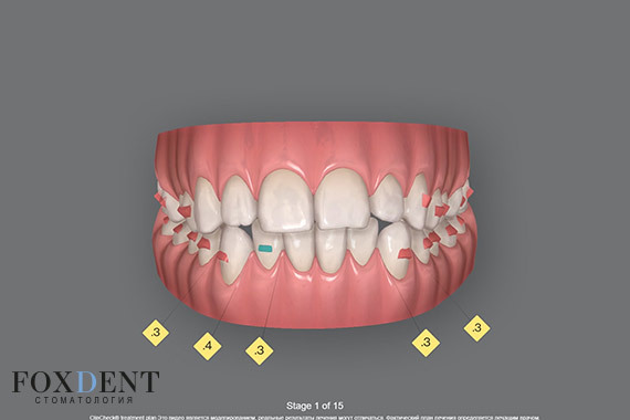 Моделирование ортодонтического лечения