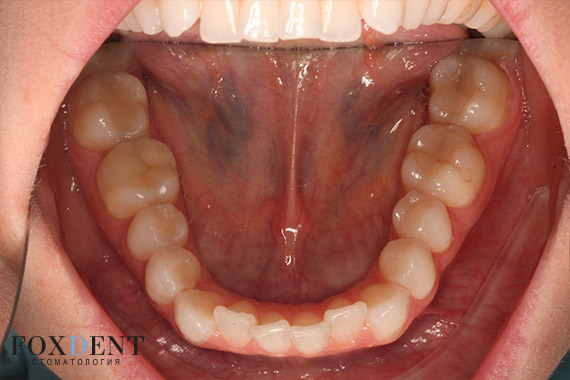 Зубной ряд до ортодонтического лечения