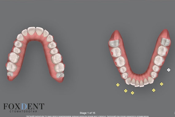 Моделирование ортодонтического лечения зубного ряда