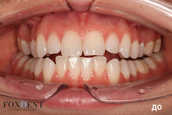 Зубной ряд до ортодонтического лечения