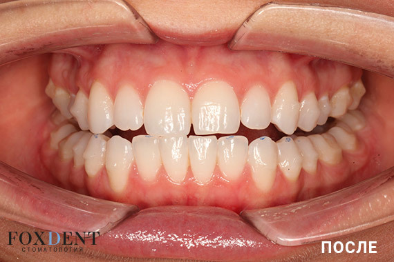 Зубной ряд после ортодонтического лечения