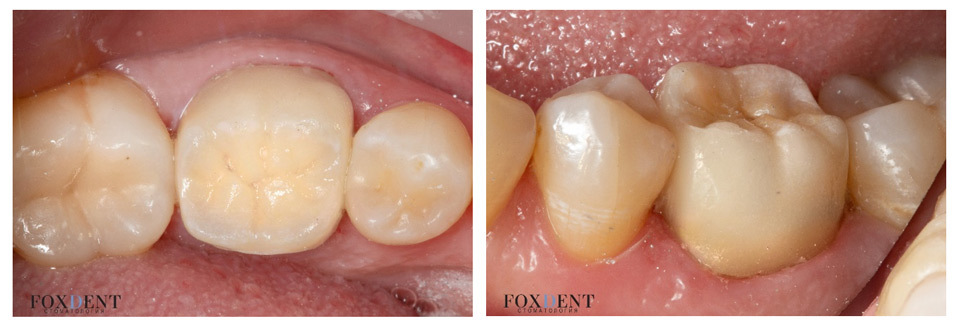 Результат восстановление зуба керамической вкладкой emax