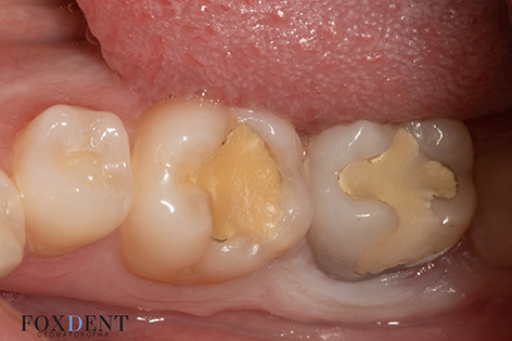 Хронический пульпит зуба
