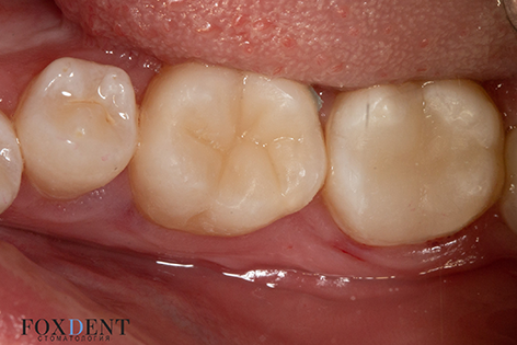Хронический пульпит зуба – лечение