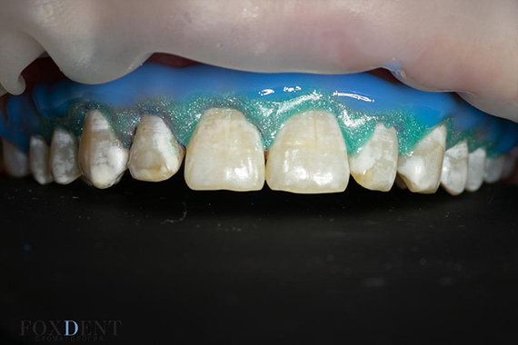 Флюороз  и гипоплазия эмали зуба – лечение - каппа