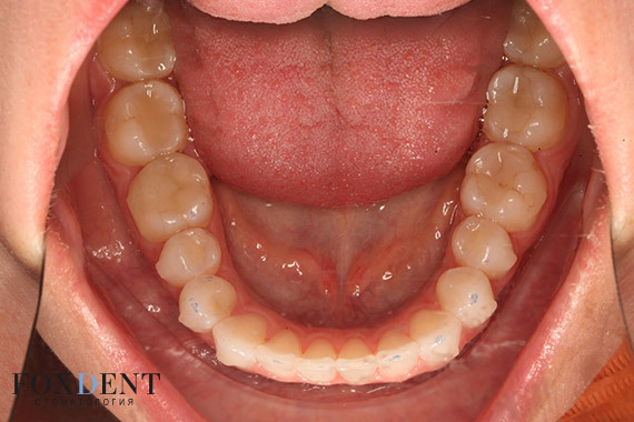 Зубной ряд после ортодонтического лечения