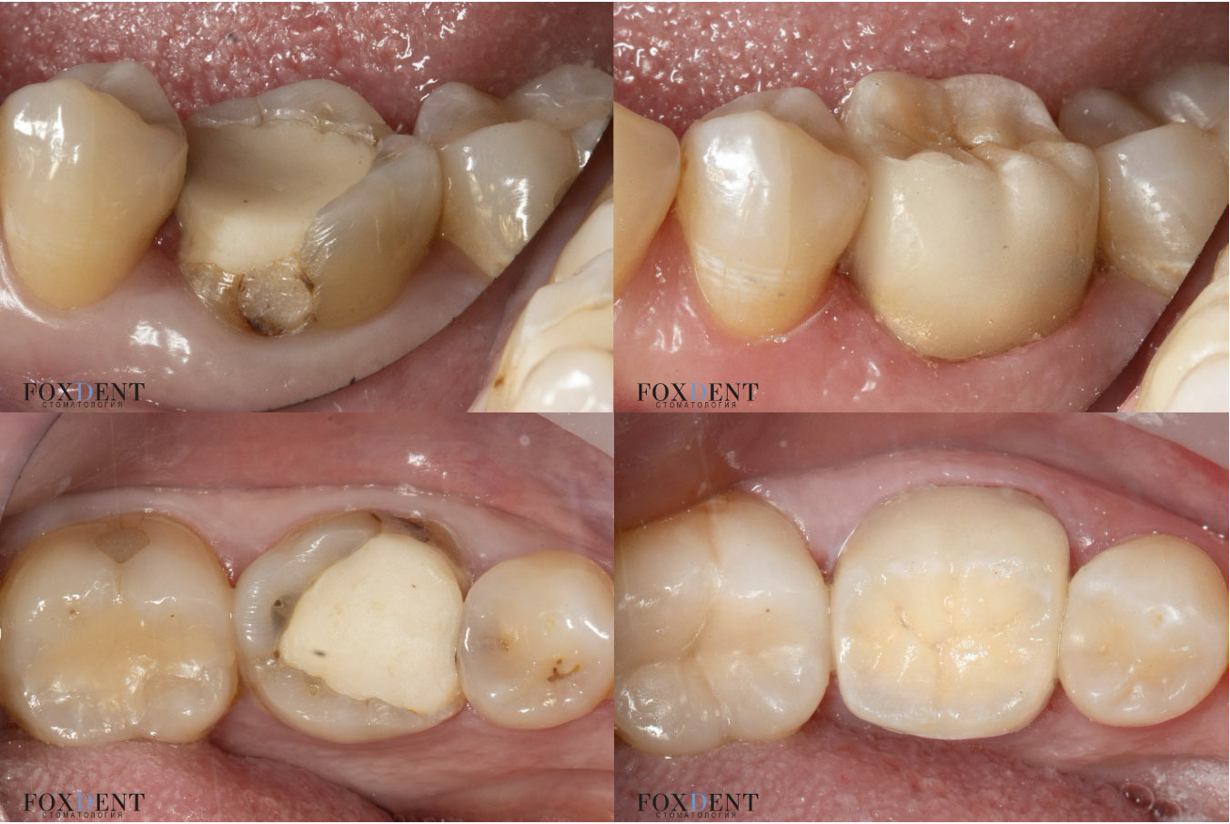 Восстановление зуба керамической вкладкой emax